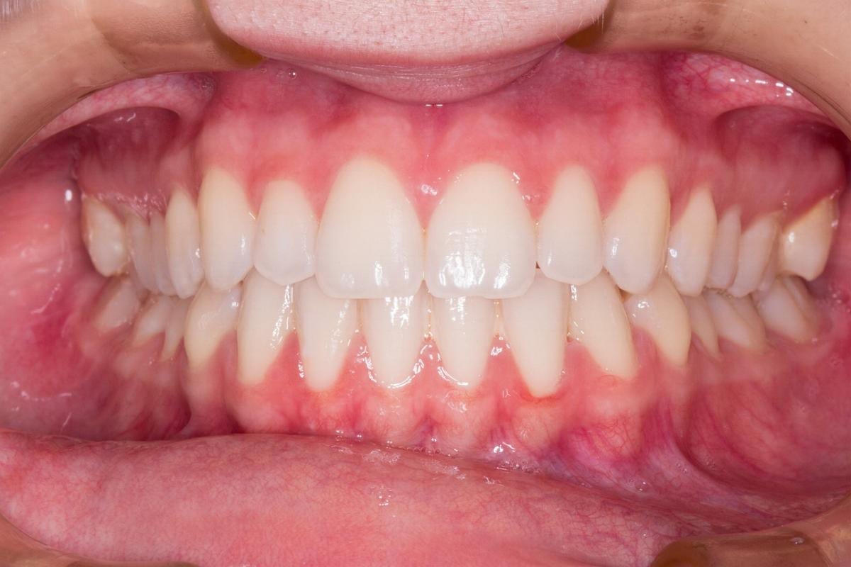 Gebiss Zahnarzt Zahn